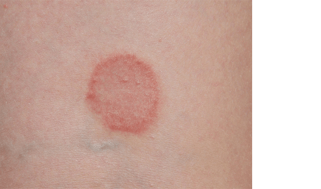 Dermatofytóza